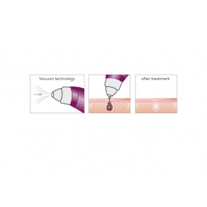 Вакуумный очиститель лица FC 41 Beurer Вакуумный очиститель лица FC 41 Beurer